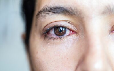 Watery Eyes: A Surprising Symptom of Dry Eye